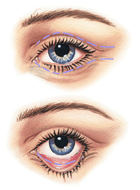 lines and creases on upper and lower eyelid made by surgeon before blepharoplasty
